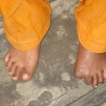 Dégats de l'arsenic